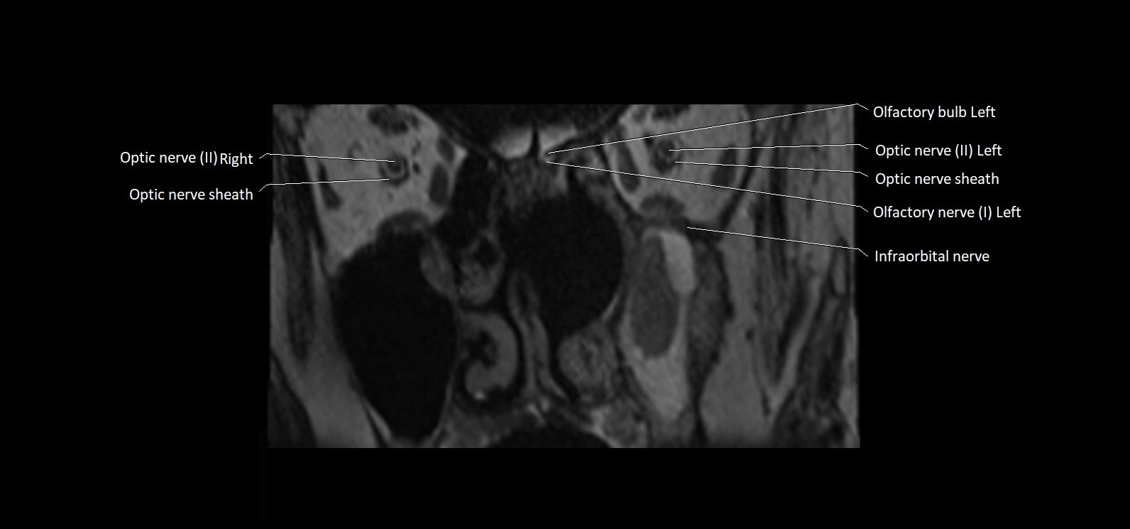 Cranial nerve cross sectional anatomy coronal 3T MRI image 4.webp